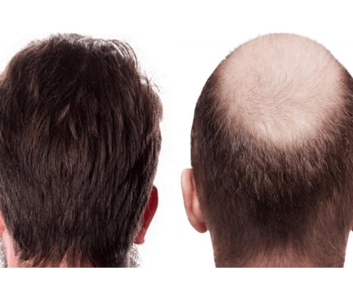 انواع روش های کاشت مو/ کاشت مو چطور انجام می شود؟