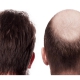 انواع روش های کاشت مو/ کاشت مو چطور انجام می شود؟