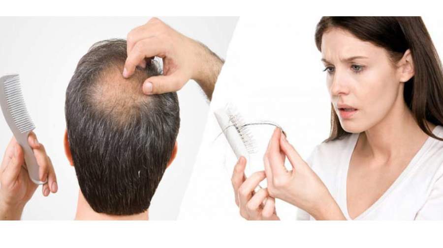 اصلی‌ترین علت ریزش مو چیست؟