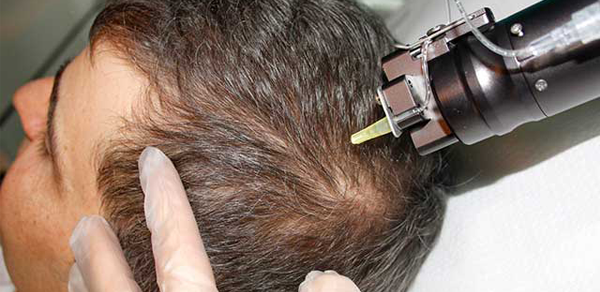 راه‌های درمان ریزش مو در مردان