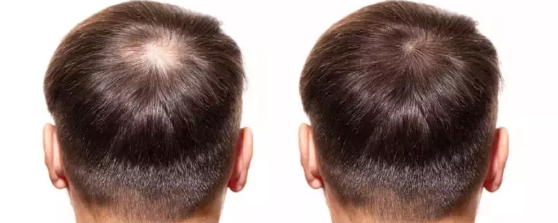 کاشت مو به روش FUE چیست؟
